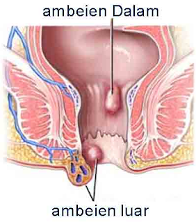 Illustration for article titled cara mengobati wasir ambeien dalam